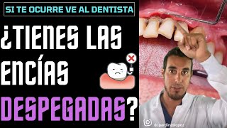 ¿Tienes las ENCÍAS DESPEGADAS Si te ocurre ESTO deberías ir al DENTISTA [upl. by Oad241]