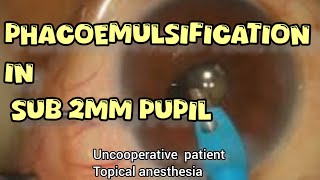 intraoperative miosis  phacoemulsification through small pupil  patience can give you rewards [upl. by Som]