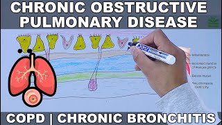 Chronic Obstructive Pulmonary Disease  COPD [upl. by Harad]