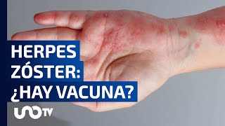 Herpes Zóster ¿Cuándo es conveniente vacunarse [upl. by Airetas]