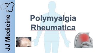 Polymyalgia Rheumatica  Signs amp Symptoms Diagnosis and Treatment [upl. by Akieluz]