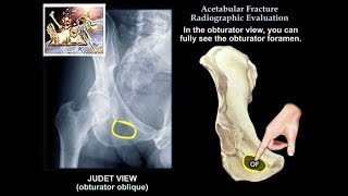 Acetabulum Fractures Surgical Approaches  Everything You Need To Know  Dr Nabil Ebraheim [upl. by Lyon]