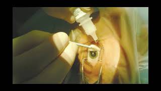 KERATOCONUS TREATMENT CORNEAL COLLAGEN CROSSLINKING C3R  NIO Pune [upl. by Alair275]