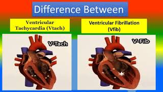 Difference Between Ventricular Tachycardia Vtach and Ventricular Fibrillation Vfib [upl. by Spevek]