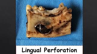 A Case of Calcifying Odontogenic Cyst [upl. by Oine]