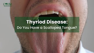 Thyroid Disease Do You Have a Scalloped Tongue [upl. by Bigot56]