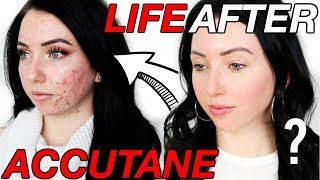 Was it Worth it 6 Months POSTACCUTANE  Lasting Side Effects Scarring Breakouts Coming Back [upl. by Vada]