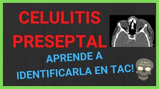 CELULITIS PRESEPTAL 👁en tomografía [upl. by Jaye]