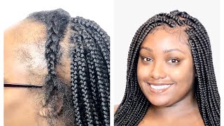 LACE FRONTAL BOX BRAIDS FOR THINNING HAIR  NO WIG NEEDED [upl. by Bernardo984]