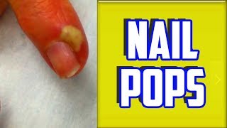 Top 4 Paronychia amp Nail Infections of All Time [upl. by Nikolia]