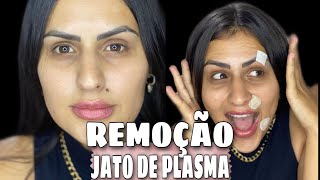 JATO DE PLASMA REMOÇÃO DE SINAL [upl. by Aleac]