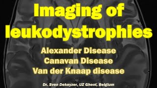 Imaging of Leukodystrophies part 1 Alexander disease Canavan disease and Van Der Knaap Disease [upl. by Casandra]