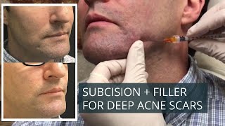 Subcision with Filler for Deep AcneScars  Affordable BoxCarScars Treatment [upl. by Dallman]