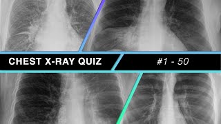 Chest Xray Quiz 1  50 [upl. by Borszcz]