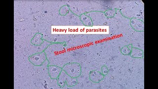 Heavy load of parasites in stool Stool microscopic examination Trichomonas hominis [upl. by Adnauqahs]