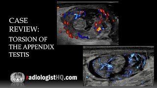 Ultrasound of Torsion of the Appendix Testis [upl. by Resneps]