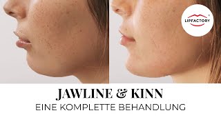 JAWLINE amp KINN  Fliehendes Kinn unterspritzen  Jawline Contouring  LIPFACTORY [upl. by Rhoads]