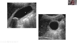 Echographie de la vésicule biliaire [upl. by Valene]