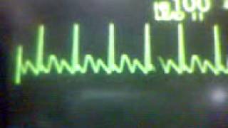 ECG Video Atrial Flutter [upl. by Sephira]