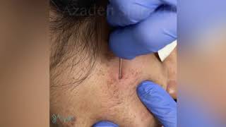 Acne Scar Subcision [upl. by Atnahsal884]