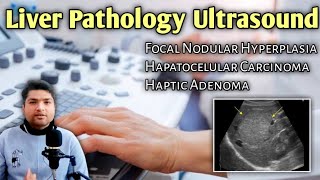 Focal Nodular Hyperplasia Hepatocellular Carcinoma amp Hepatic Adenoma  Liver Ultrasound Explained [upl. by Tatiania]