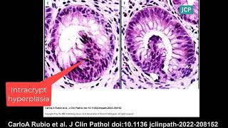 Novel crypt anomalies in inflammatory bowel disease [upl. by Nnairek]