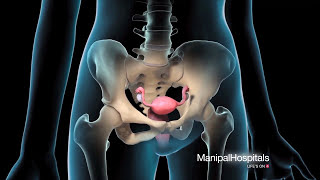 Endometrial Hyperplasia  CRASH Medical Review Series [upl. by Salohci680]