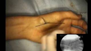 Percutaneous Transtrapezial Scaphoid Fixation [upl. by Lertnek166]