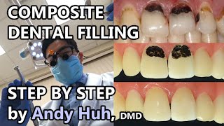 Composite Dental Filling Procedure Steps Toothcolored White 레진 충치 치료 Andy Huh  Evergreen Dental [upl. by Aken]