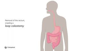 Anatomy of Loop Colostomy Creation [upl. by Arik]