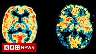 US approves first new Alzheimers drug in 20 years  BBC News [upl. by Rochus978]