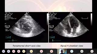 21 06 04 Echocardiogram interpretation [upl. by Burnley]