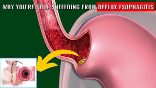 Symptoms of GERD Gastroesophageal Reflux Disease – Dr Berg [upl. by Nimoynib603]