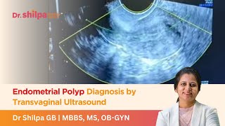 Endometrial Polyp Diagnosis by Transvaginal Ultrasound  Dr Shilpa G B [upl. by Ho216]