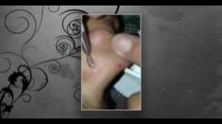 Huge Blackheads Pop on Nose  Black head [upl. by Nolur]