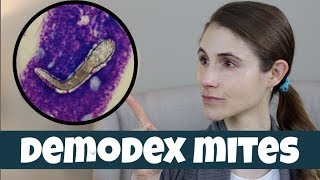 DEMODEX MITES ON YOUR SKIN DR DRAY [upl. by Marguerita]