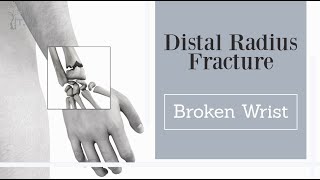 broken wrist  distal radius fractures subtitled [upl. by Buffum]