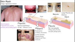 Understanding Rash in 3 minutes Skin Rash types and causes [upl. by Orihakat]