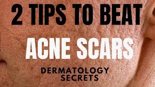 Acne scar treatments ULTIMATE GUIDE [upl. by Elboa]