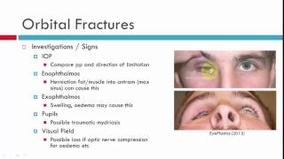 Blow Out Fractures Chatacteristics [upl. by Dorcas986]