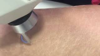 CO2 Laser for Stretch Marks by Dr Kassir [upl. by Barris589]