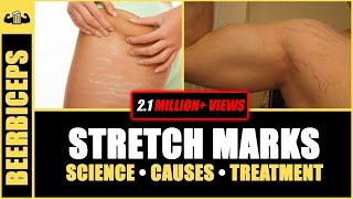 GOODBYE FOREVER  Stretch Marks  Stretch Marks Science Causes amp Treatment  BeerBiceps [upl. by Klenk762]