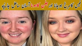 Fece Redness treatment at homechehre ki Redness khatam karne ke 2Asan tarike [upl. by Ganiats225]