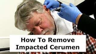 Removing Impacted Cerumen from a Patients Ear [upl. by Hoenack520]