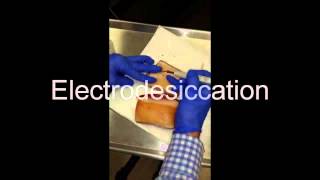 Electrodesiccation and Curettage EDampC  How To [upl. by Nali11]