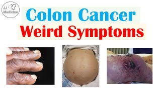 Colon Cancer Weird Symptoms amp Why They Occur [upl. by Aennyl]