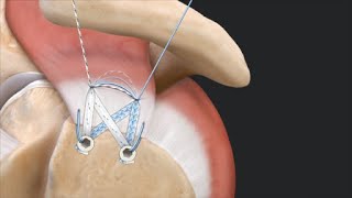 SpeedBridge™ Rotator Cuff Repair Using Tensionable Knotless SwiveLock ® Anchors [upl. by Homer]