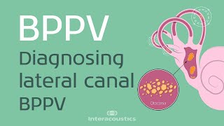 How to Diagnose Lateral Canal BPPV [upl. by Tnert]