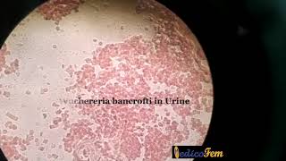 Wuchereria bancrofti in Urine [upl. by Correy]