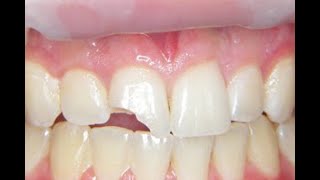 Fix a Chipped or broken tooth at home cheap [upl. by Ielhsa813]